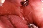 Oral candidiasis - HIV