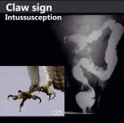 Intussusception