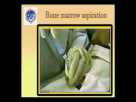 Pediatric Bone Marrow Aspiration