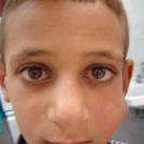 Salivary Gland Diseases