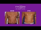 VASER High Definition Liposuction by Dr. Sanjay Parashar