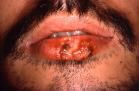 Recurrent herpes labialis