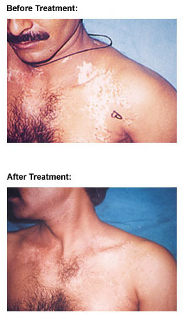 Vitiligo surgery or leucoderma