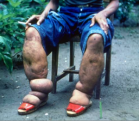 Elephantiasis
