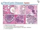 Clinical Pathology Lecture - Breast Disorders