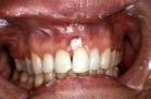 Gingival squamous cell carcinoma