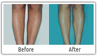 Legs Hair Removal