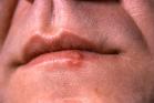 Herpes simplex