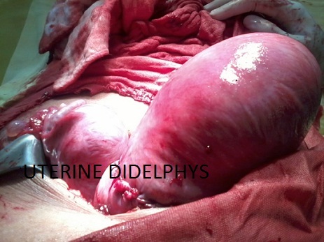 uterine didelphys