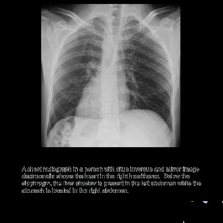 Dextrocardia Situs Inversus