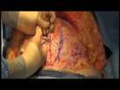 Abdominoplasty (Tommy Tuck ) Surgery