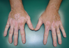 Vitiligo