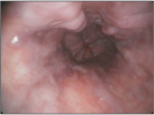 Esophageal Varices