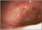Gastric Ulcer