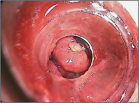 Endoscopic Variceal Band Ligation
