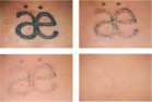 Easy Methods for Tattoo Removal