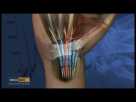 Carpal tunnel syndrome