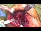 Total Shoulder Arthroplasty - Dr. Richard Hawkins