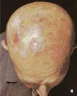 Actinic Keratosis (AK)