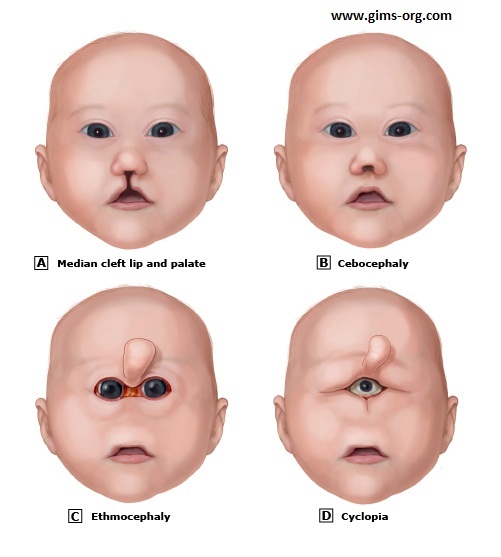 Holoprosencephaly spectrum