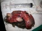 Dermoid cyst (mature teratoma)