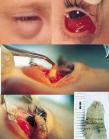 The larva of a human botfly was removed from a child's eye