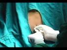 Lumbar Puncture