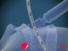 Endotracheal Intubation