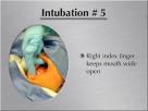Intubation-How to perform endotracheal intubation #1