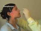 Collection of Nasopharyngeal Specimens with the Swab Technique
