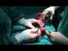 Postectomy for Phimosis