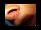 Nasal Septum Abscess-Treatment