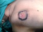 Paget's disease of nipple with surrounding peau de orange'