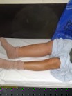 4th stage lymph edema case