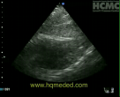 stab to RV pericardial clot subcostal
