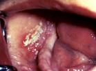 Candidiasis in HIV