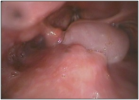 Hypopharyngeal Cyst