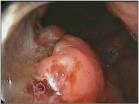 Malignant Gastric Ulcer