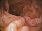 Intestinal Lymphangiectasia