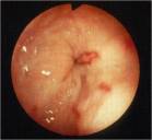 Lower Esophageal Stricture with Ongoing Esophagitis