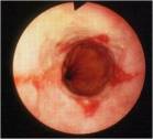 GERD – Erosive Esophagitis (LA Type A)