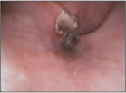 Koch’s Ulcer Esophagus
