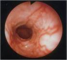 GERD – Severe Erosive Esophagitis (LA Type C)