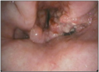 Hypopharyngeal Neoplasm
